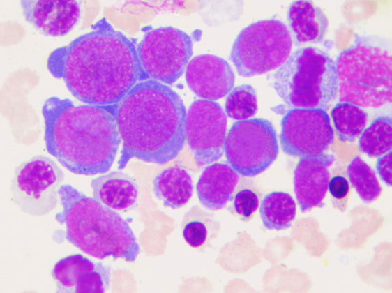 下伴原粒细胞或原始单核细胞≥30%(非红系细胞计数即可),即为红白血病